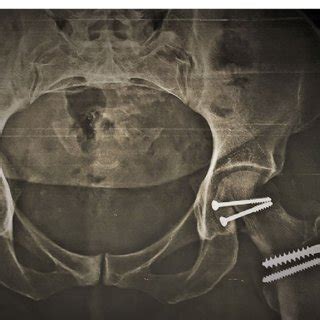 pimayone|Ganz surgical hip dislocation pdf.